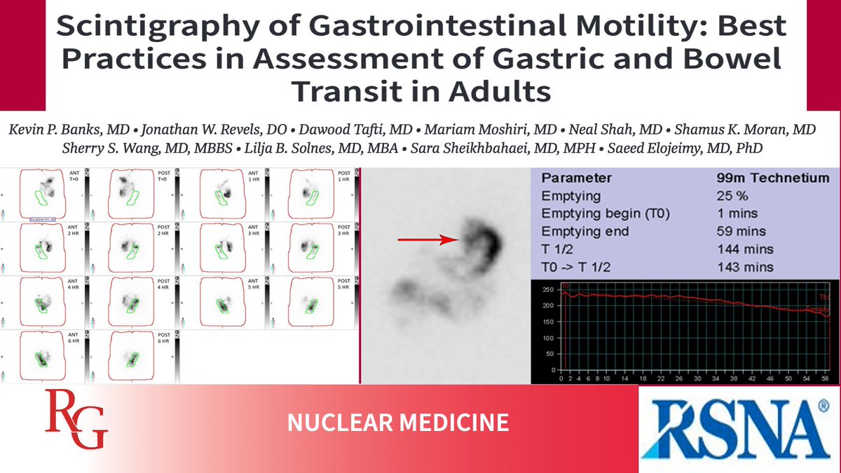 Sarah Bastawrous, DO (@sbastawrous1) on Twitter photo GI transit scintigraphic exams play a central role in diagnosis & treatment of GI disorders & are developed for use in evaluating small & large bowel transit. Let’s learn more from Banks and team! 1/7
bit.ly/45jMgq4
#RGphx #NucMed
<a href="/Radiographics/">RadioGraphics</a> <a href="/elojeimy/">Saeed Elojeimy</a> GI transit scintigraphic exams play a central role in diagnosis & treatment of GI disorders & are developed for use in evaluating small & large bowel transit. Let’s learn more from Banks and team! 1/7
bit.ly/45jMgq4
#RGphx #NucMed
<a href="/Radiographics/">RadioGraphics</a> <a href="/elojeimy/">Saeed Elojeimy</a>
