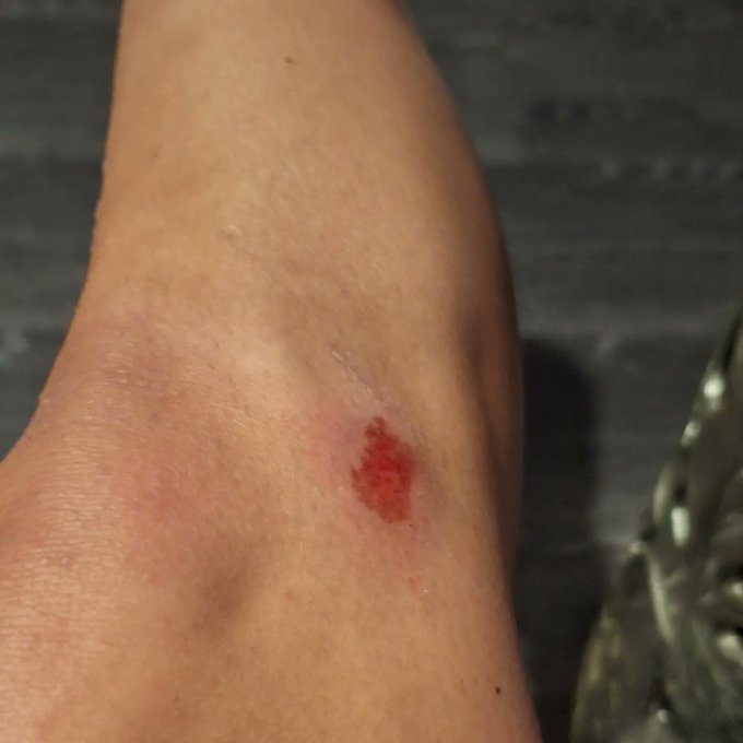 The journey continues.. block 3 here we come...  celebratory cheesecake n a skint knee 💪 #prowrestling<a href="/tag/gymlife"class="tags"><span>#gymlife</span></a><a href="/tag/trainhard"class="tags"><span>#trainhard</span></a><a href="/tag/cheesecake"class="tags"><span>#cheesecake</span></a><a href="/tag/prowrestling"class="tags"><span>#prowrestling</span></a>