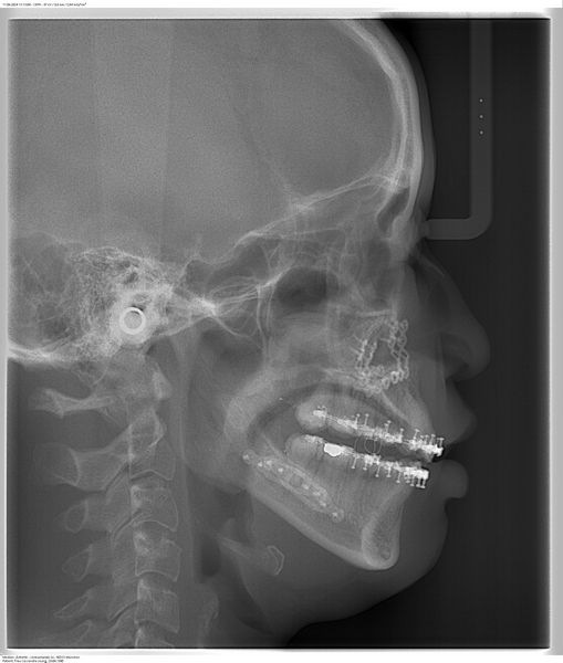 CassandraPatati's tweet photo. 3 weeks PO #DJS Got my splint out, x-rays back, and now need to wear six elastics for at least the next two weeks 😱 These buttons / hooks on the inside are already irritating me so much 😓 #DoubleJawSurgery https://t.co/xv9tKuJ43Y
