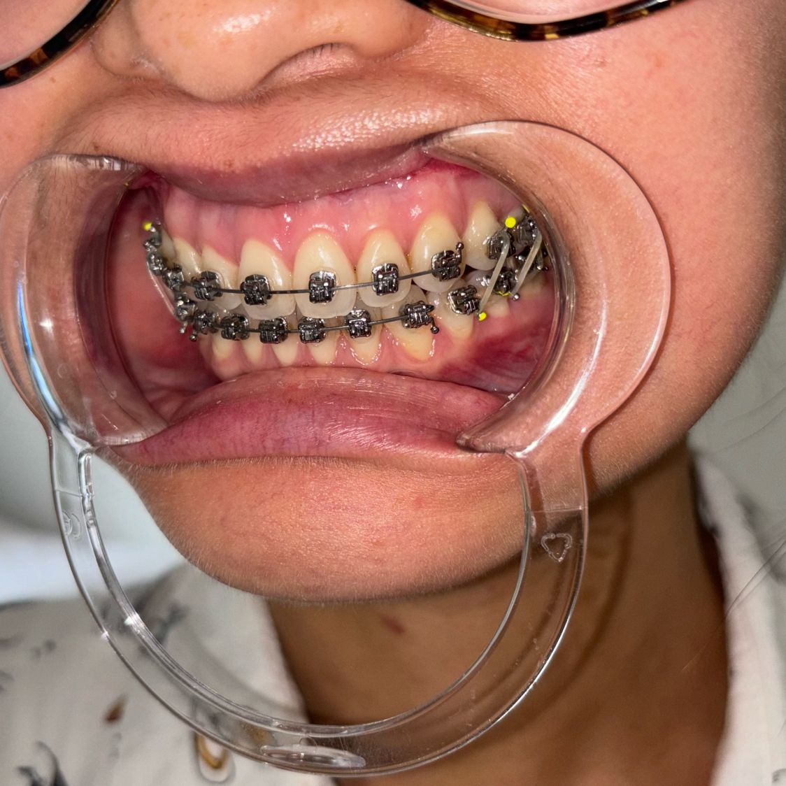 CassandraPatati's tweet photo. 3 weeks PO #DJS Got my splint out, x-rays back, and now need to wear six elastics for at least the next two weeks 😱 These buttons / hooks on the inside are already irritating me so much 😓 #DoubleJawSurgery https://t.co/xv9tKuJ43Y