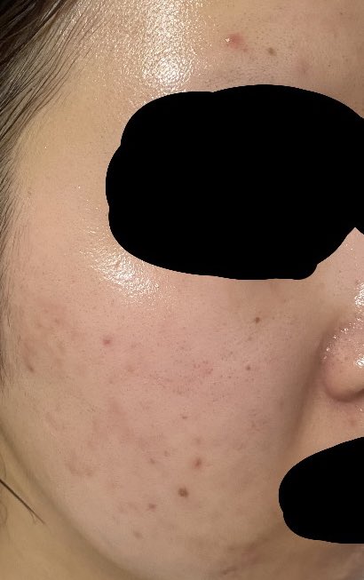 去年の今頃よりはマシだけど今年も再発ですか
ニキビできてない時がない一生綺麗になれない気がする
今週はこれで脱毛行くよ