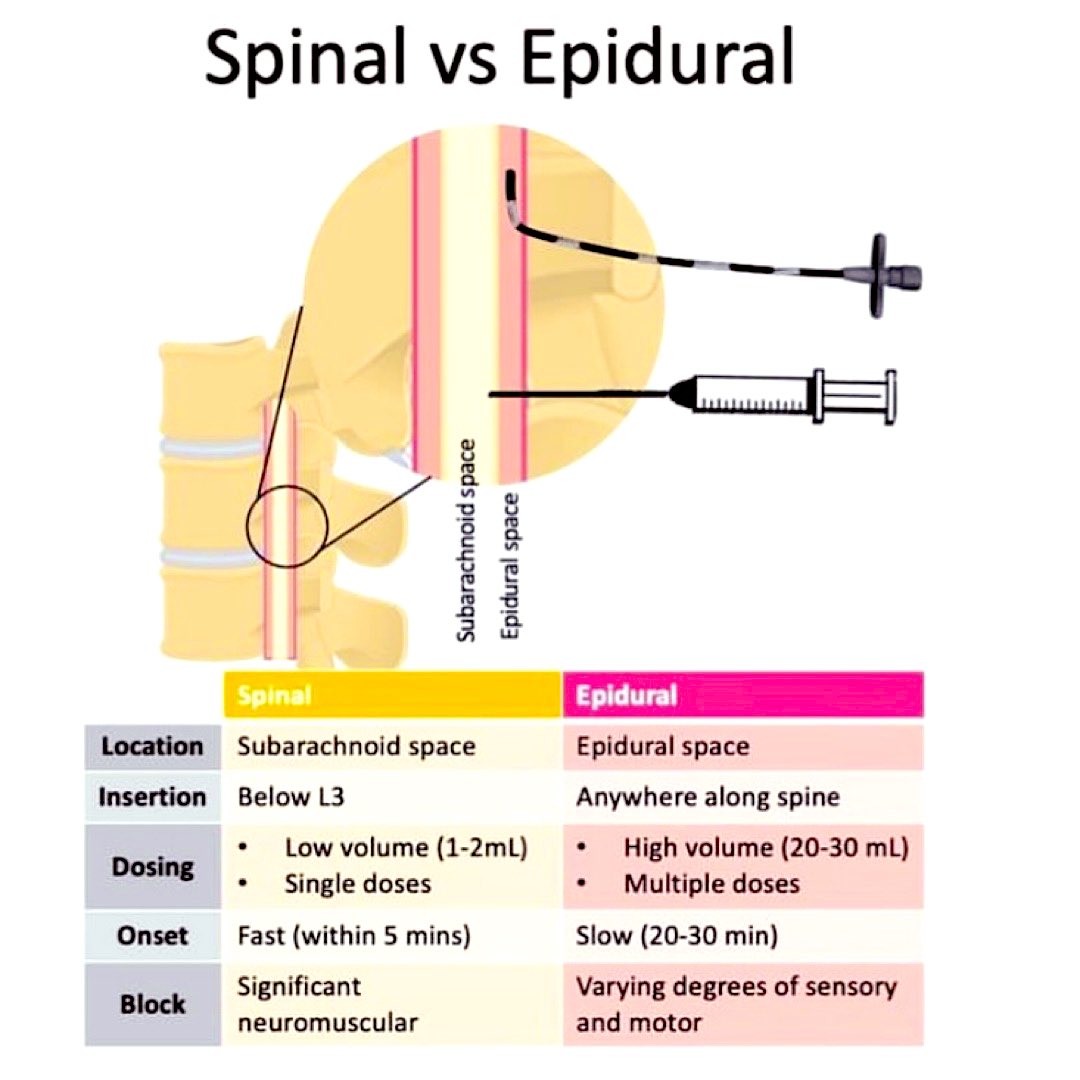 Spinal &amp; epidural Anaesthesia ‼️