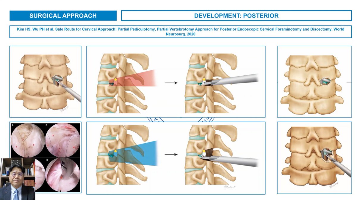 OOTESJ's tweet photo. Endoscopic Spine SurgeryMaster Lectures

ANATOMICAL CONSIDERATION OF POSTERIOR
ENDOSCOPIC CERVICAL FORAMINOTOMY
by Kim Hyeun-Sung Harrison MD, PhD from South Korea

https://t.co/ekXAdUqQiv

#surgeon #OOT #surgery #surgeryvideo #openoperatingtheatre #ootvideo #masterlectures https://t.co/pGEbOzrMAk