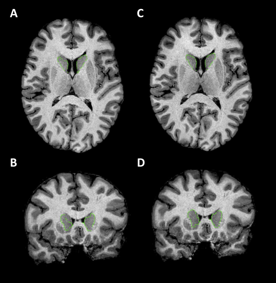 Journal of Huntington's Disease tweet media