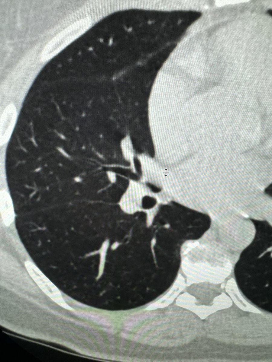 Joe Mammarappallil (@jmammarappallil) on Twitter photo What a way to start the academic year <a href="/DukeRadiology/">Duke Radiology</a> <a href="/DukeRadCTI/">DukeCTI</a> !!! Organizing pneumonia 💥! Resolved after prednisone 2 months later (3rd pic) Dang we have the best pathology for all of our learners! 🔥🩻🫁 <a href="/thoracicrad/">Society of Thoracic Radiology</a> <a href="/atscommunity/">American Thoracic Society (ATS)</a> <a href="/accpchest/">CHEST</a> What a way to start the academic year <a href="/DukeRadiology/">Duke Radiology</a> <a href="/DukeRadCTI/">DukeCTI</a> !!! Organizing pneumonia 💥! Resolved after prednisone 2 months later (3rd pic) Dang we have the best pathology for all of our learners! 🔥🩻🫁 <a href="/thoracicrad/">Society of Thoracic Radiology</a> <a href="/atscommunity/">American Thoracic Society (ATS)</a> <a href="/accpchest/">CHEST</a>
