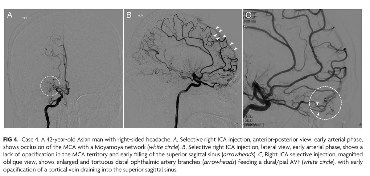 TheAJNR's tweet photo. "Concurrent Moyamoya-like Intracranial Steno-Occlusive Disease and Dural Arteriovenous Fistulas"
https://t.co/Ikoehm4k32
#Moyamoya #dAVF @GLanzinoNSGY https://t.co/KXiXxDiwc3