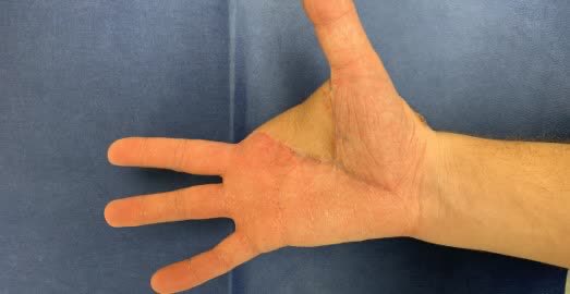 DebraSchindler's tweet photo. Short fuses and dud fireworks are the biggest reason hand surgeons at MedStar Health's Curtis National Hand Center keep busy this time of year. Celebrate #IndependenceDay safely. Click here for #FireworksSafety tips #MedStarHealth #CurtisNationalHandCenter https://t.co/urFzbMh0bv https://t.co/Sd2wbzvPWz