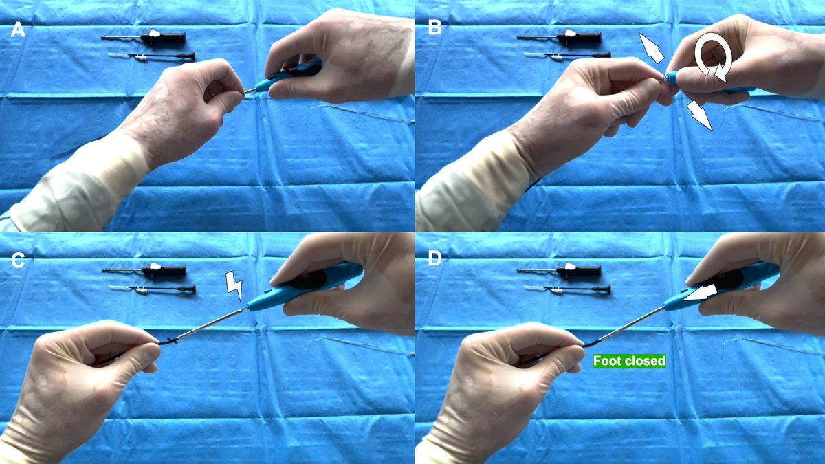 Radoslaw Parma (@parma) on Twitter photo 😠Have you experienced a trapped Proglide/Prostyle?
👉<a href="/Omar_A_Oliva/">Omar Oliva</a> and Antoine Sauguet from Clinique Pasteur Toulouse 🇫🇷 share their tips on hiding the👣by breaking the metal part!
📰Learn from them <a href="/PCRonline/">PCRonline 🫀</a> My Toolkit: pcronline.com/Cases-resource…
<a href="/sbrugaletta/">Salvatore Brugaletta</a> <a href="/kiadeb87/">Chiara De Biase</a> 😠Have you experienced a trapped Proglide/Prostyle?
👉<a href="/Omar_A_Oliva/">Omar Oliva</a> and Antoine Sauguet from Clinique Pasteur Toulouse 🇫🇷 share their tips on hiding the👣by breaking the metal part!
📰Learn from them <a href="/PCRonline/">PCRonline 🫀</a> My Toolkit: pcronline.com/Cases-resource…
<a href="/sbrugaletta/">Salvatore Brugaletta</a> <a href="/kiadeb87/">Chiara De Biase</a>