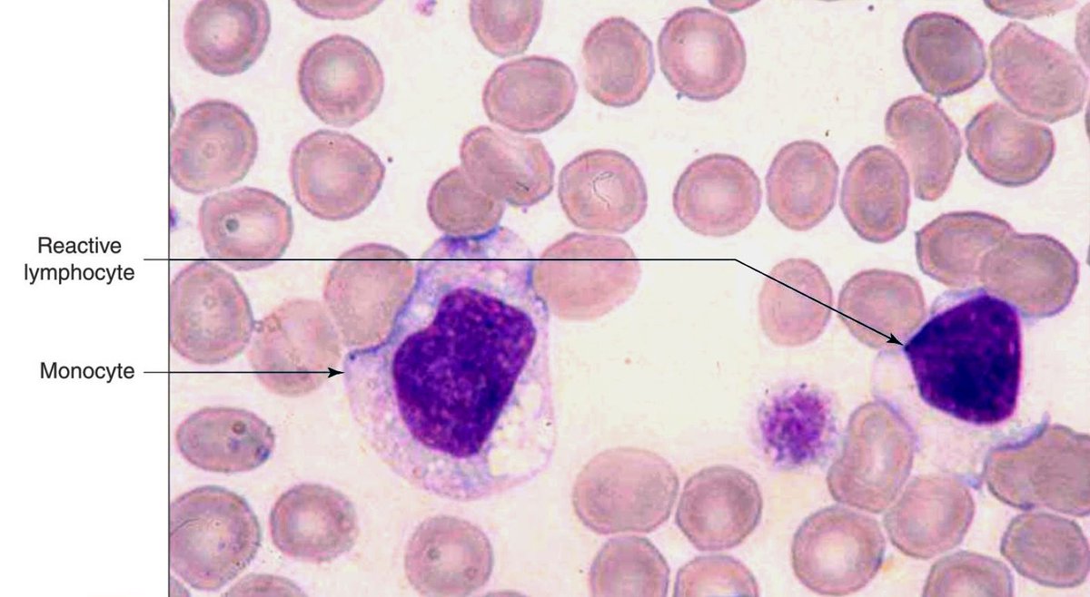 Dave_it_up's tweet photo. COVID-19 Infecting Blood Monocytes, Oh my!

COVID-19 has profoundly impacted global health, economies, and daily life. The disease can lead to multi-organ complications and long-term health issues, now officially named "Long COVID.". The damage of Long COVID can persist from months to years and include fatigue, shortness of breath, cognitive issues, and organ damage[1][4][7].

The Role of Monocytes in COVID-19

Monocytes are a type of white blood cell that plays a crucial role in the body's immune response. They are part of the innate immune system and are responsible for phagocytosing pathogens and presenting antigens to T cells. In the context of COVID-19, monocytes have been found to be significantly affected by the virus, leading to various immune dysregulations.

Infection and Activation of Monocytes

Research has shown that SARS-CoV-2 can infect blood monocytes, which are then activated to produce inflammatory responses. Approximately 10% of blood monocytes in COVID-19 patients are infected with the virus[3][16]. The infection of monocytes triggers the formation of inflammasomes, which are multiprotein complexes that play a key role in the inflammatory response. This activation leads to a form of cell death known as pyroptosis, which releases pro-inflammatory cytokines and exacerbates inflammation[3][10].

Dysregulation and Long-term Effects

Monocyte dysregulation is not limited to the acute phase of COVID-19. Studies have found that even after the resolution of the initial infection, monocytes in convalescent patients exhibit altered levels and activation states. This dysregulation can last for several months and may contribute to the development of Long COVID symptoms, particularly pulmonary complications[2][12]. Elevated levels of specific monocyte subsets, such as CD14^+CD16^+ monocytes, have been associated with severe COVID-19 and long-term pulmonary issues[2][8].
Consequences of Monocyte Infection
The infection and subsequent activation of monocytes by SARS-CoV-2 have several significant consequences:

1. Hyperinflammation: The activation of inflammasomes in monocytes leads to the release of large amounts of pro-inflammatory cytokines, contributing to the cytokine storm observed in severe COVID-19 cases[3][6]. This hyperinflammatory state can cause extensive tissue damage and multi-organ failure.

2. Immune Dysregulation: The infection of monocytes disrupts their normal function, leading to impaired pathogen recognition and antigen presentation. This can result in an inadequate immune response and prolonged infection[12][18].

3. Long-term Health Issues: Persistent monocyte dysregulation can lead to chronic inflammation and contribute to Long COVID symptoms, including respiratory issues, fatigue, and cognitive impairments[1][4][7].

4. Potential Therapeutic Targets: Understanding the role of monocytes in COVID-19 pathophysiology opens up potential therapeutic avenues. Targeting the pathways involved in monocyte activation and inflammasome formation could help mitigate the severe inflammatory responses and improve patient outcomes[5][10].

The infection of monocytes by SARS-CoV-2 is a critical factor in the pathogenesis of COVID-19. It leads to significant immune dysregulation and contributes to both the acute severity of the disease and the long-term complications experienced by many patients. Continued research into the mechanisms of monocyte infection and activation is essential for developing targeted therapies to treat and prevent the severe consequences of COVID-19.