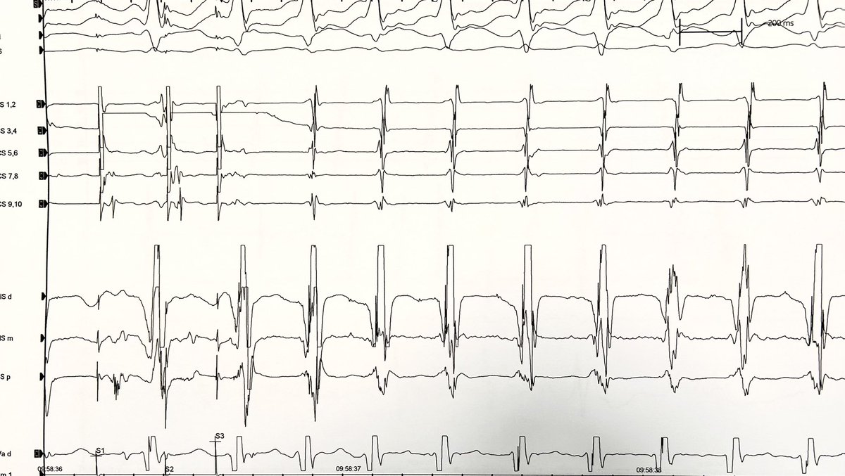 Middle-aged man with effort-induced fast AVNRT episodes.
Pacing maneuvres revealed dual AV nodal physiology.
AVNRT was then induced under isoproterenol infusion.
Postero-septal RF ablation was safely performed with a successfull abolition of the slow pathway!