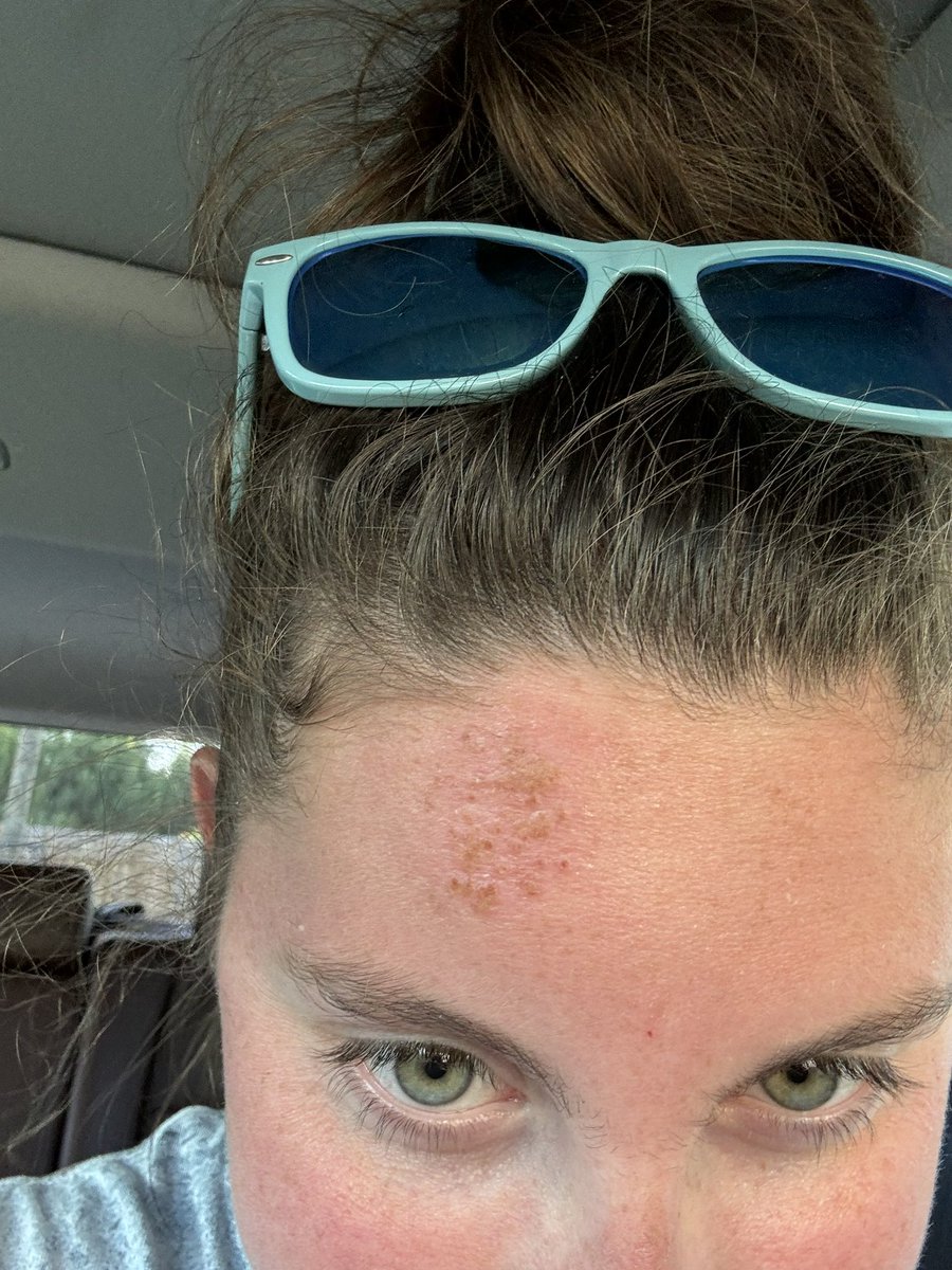 bstillmassage's tweet photo. @LaRochePosayUSA my girlfriend used this product at the beach &amp; it caused some type of chemical burn on her face. Is there any treatment for it https://t.co/GySMlamb5v