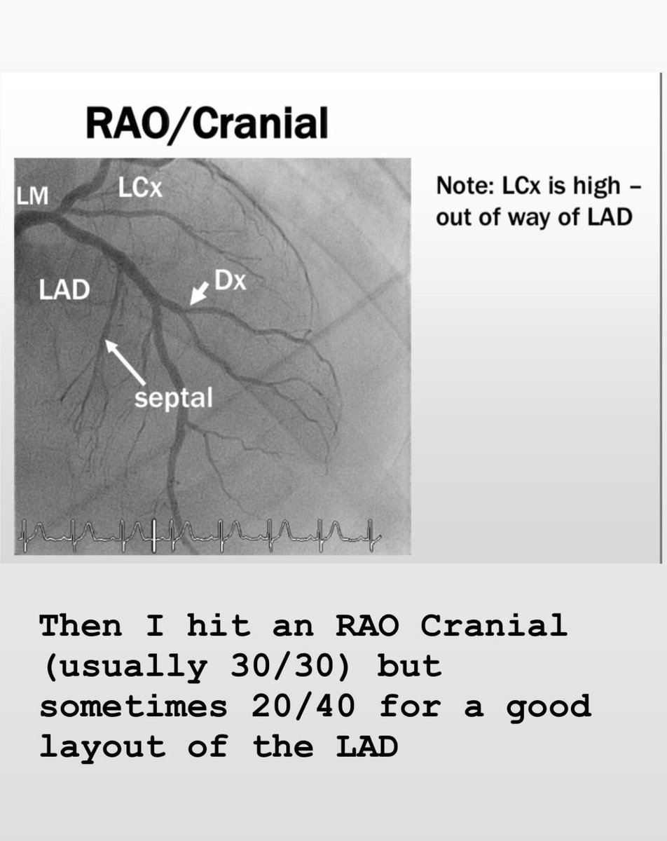 DrJayMohan's tweet photo. 6/  then I hit RAO cranial (30/30) 

Great view to lay out the LAD with the septal/diagonal bifurcation 

#Cardiology #Cardiotwitter #FellowBootCamp https://t.co/ORXoNzwVuI