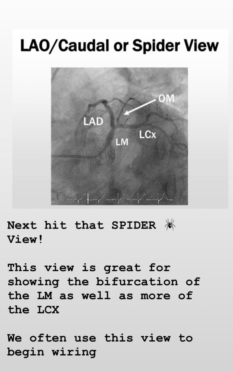 DrJayMohan's tweet photo. 9/ last my favorite view! SPIDER! LAO CAUDAL. 

This view shows the left main bifurcation. It’s a great view to start wiring to help you see where the Lcx and LAD are! 

#Cardiology #Cardiotwitter #FellowBootCamp https://t.co/ajAizFZiSD