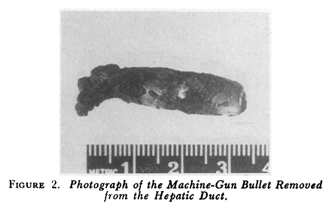 From the NEJM Archive: Obstructive Jaundice Due to Bullet in Hepatic Duct — Report of a Case after a Latent Period of Nine Years (Original Article, July 1, 1954) nej.md/3VULyfQ