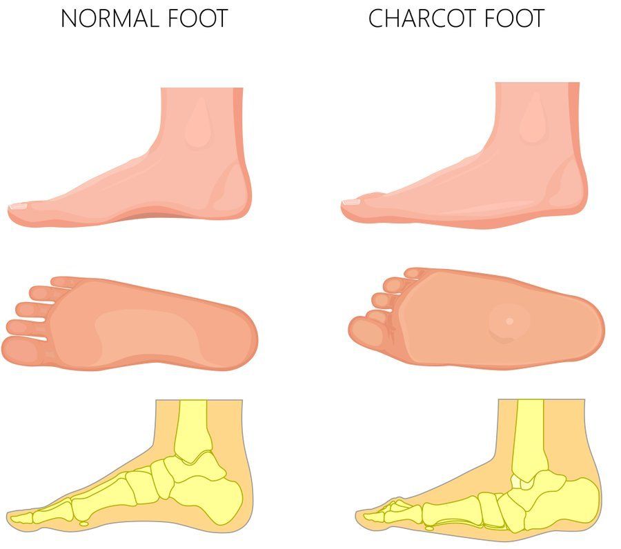 DGArmstrong's tweet photo. Diagnosis and treatment of active Charcot neuro‐osteoarthropathy in persons with diabetes mellitus: A systematic review https://t.co/yjeRpkpCz7 https://t.co/O2Z7b2fMJ6