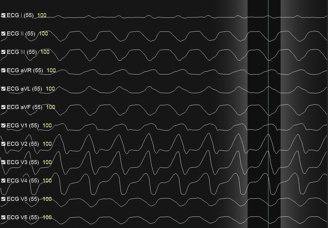 What would you do if the VT is too unstable to map or entrain? Let’s look at how understanding VT substrate is paramount in this case.