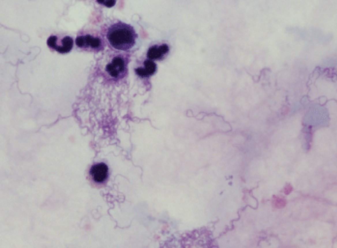 #idboardreview Refugee from Eritrea presents with fever, abd pain, petechial rash, jaundice, leukopenia, anemia, thrombocytopenia, giemsa thick film shown #idxposts #idmeded #MedEd
