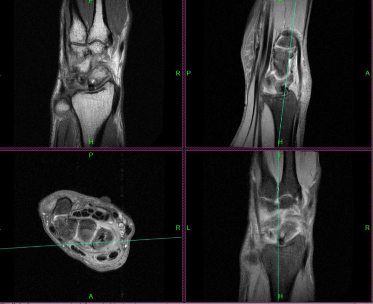 KenSheah's tweet photo. Scaphoid fixation. Proud screw head with distal radius chondromalacia https://t.co/6D8sSInT7W