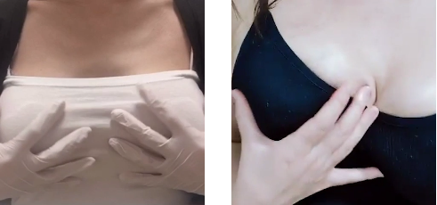 mdclinic2001's tweet photo. 乳房二次手术的合适时机是什么时候呢？
建议初次手术 6个月后再进行二次手术。
在乳房形状和组织固定之前，草率地进行二次手术时，可能会产生意想不到的副作用。
但是，遇到假体破裂或包膜挛缩等紧急情况时，需与主治医生商议后尽快进行二次手术。#包膜挛缩 #乳房二次手术 #隆胸修复 #韩国隆胸 #韩国MD https://t.co/hluQdFmyGD