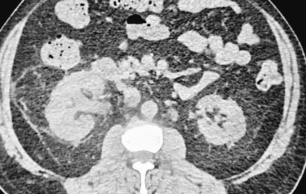 abdo_imaging's tweet photo. Poorly controlled - DM
Hydro-ureteronephrosis
No ureteric cal

Diagnosis high on the list:

"Urteric obstruction due to necrosed papilla" 

You have to prompt it to your urologist..or it might be treated as usual pyelonephritis.
#MedTwitter #FOAMed #Radiology @AJR_Radiology https://t.co/ew3YDmKdrH