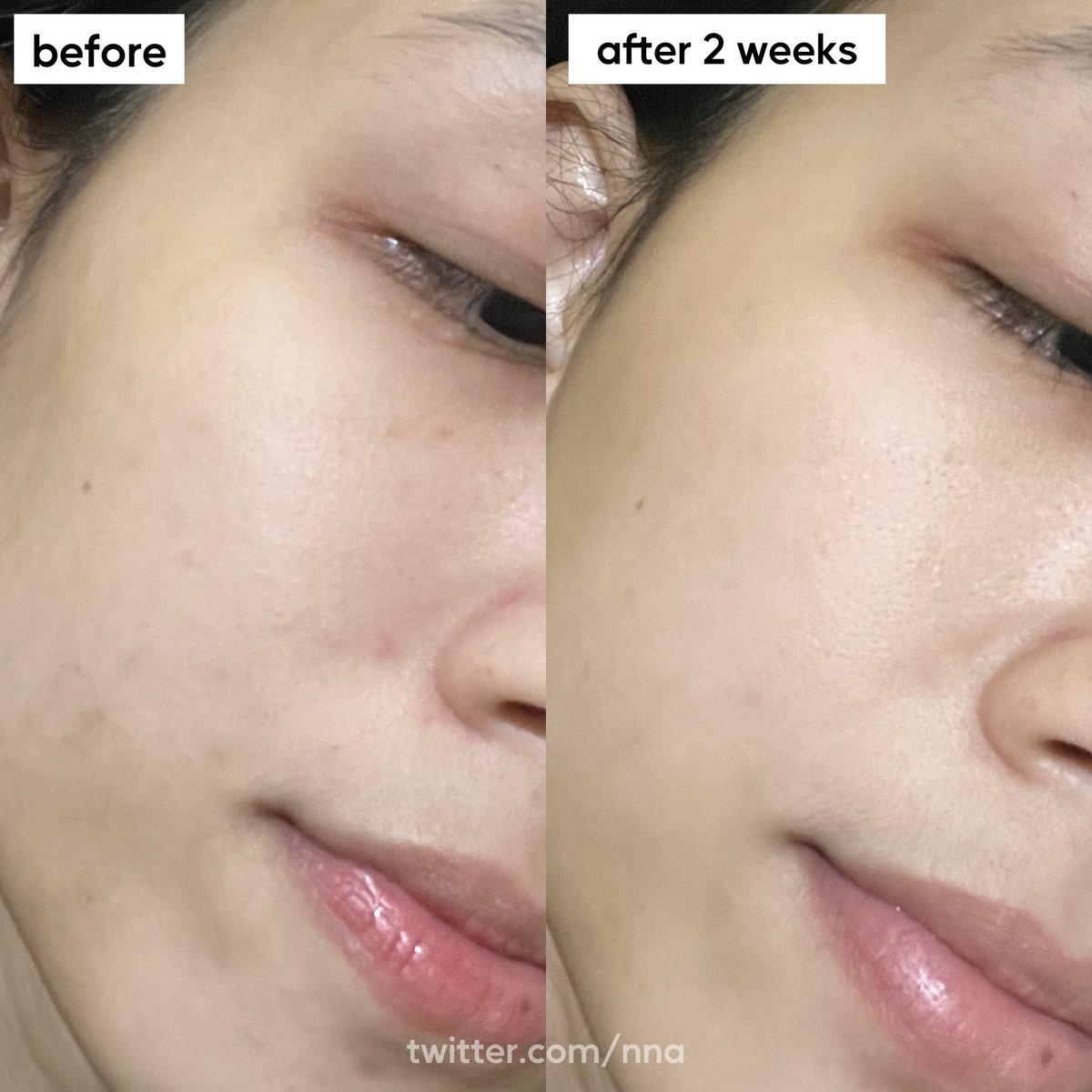 nna's tweet photo. klo kamu suka ngeluh kulitnya kusam, kasar, bekas jerawat lama bgt ilangnya… cobain deh mulai rutin ✨eksfoliasi✨

nih ya aku spill kuncian aku buat kulit sehat, tekstur smooth &amp; glowing modal rajin exfo pake peeling serum aja tiap minggu #racuninskincare https://t.co/BWRSKT2GRF
