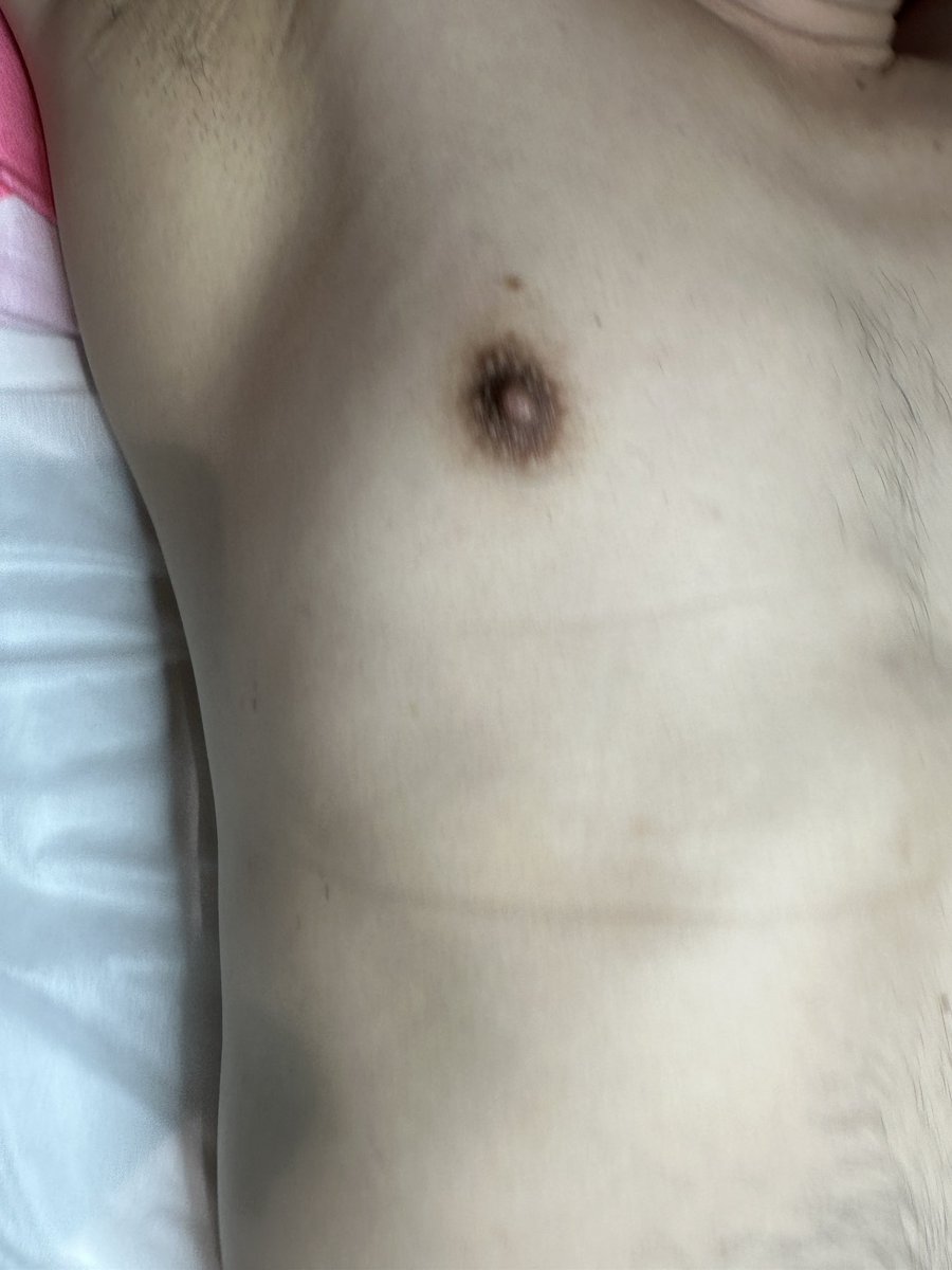 cyxscd's tweet photo. 两次腋下脱毛后的效果#男士脱毛 https://t.co/xaXvaFVdLM