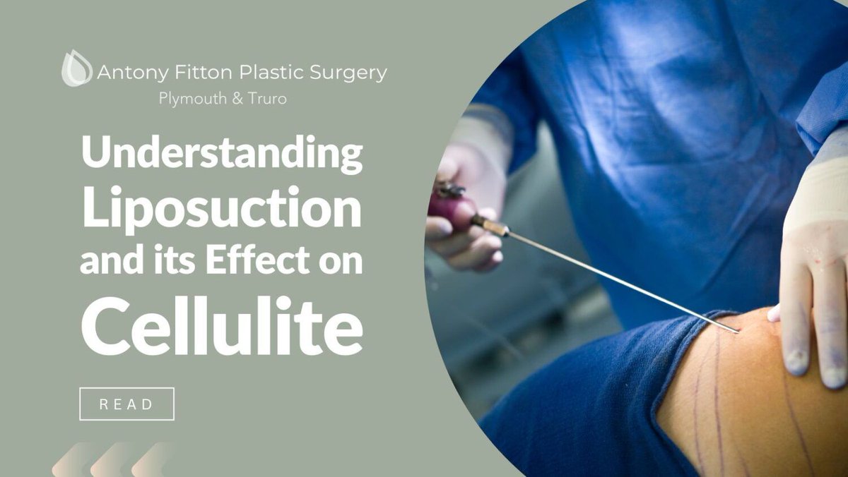 AntonyFitton's tweet photo. ➡️ What is Cellulite?

     and

➡️ Does #Liposuction Remove #Cellulite? 🤔

https://t.co/8C8OOPYeTm

#LiposuctionFacts #ContouringProcedure #NotACelluliteSolution #FatRemoval #SculptingTreatment #LiposuctionJourney #EnhancedAppearance #ConfidenceBoost #BodyContouring https://t.co/4nk1ylaY4q
