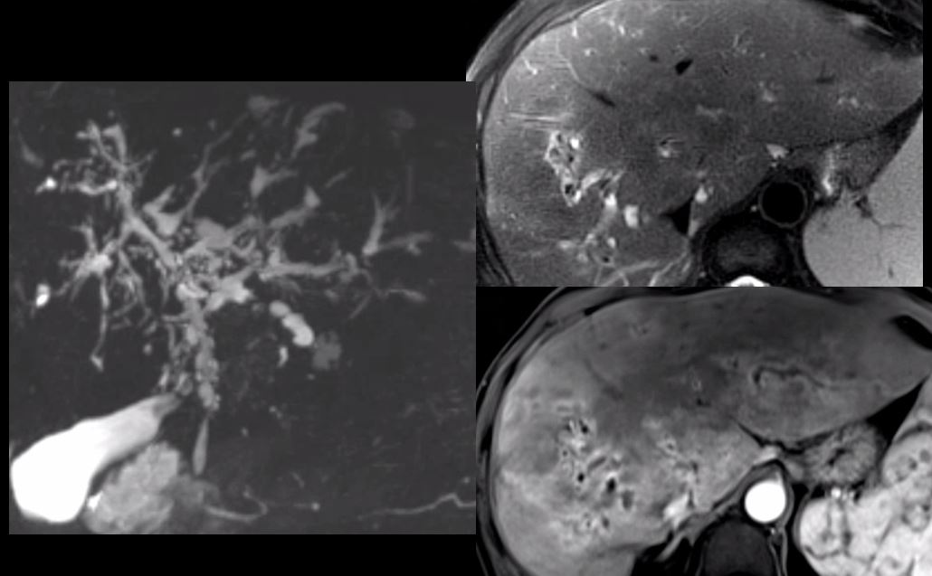 Test Yourself! A 55-yo man with history of ulcerative colitis presents with fever, right upper quadrant pain, and LFT abnormalities. MRCP MIP image, axial T2-weighted image with fat sat, and axial T1-weighted post-contrast image with fat sat. Answer will be posted in a week.