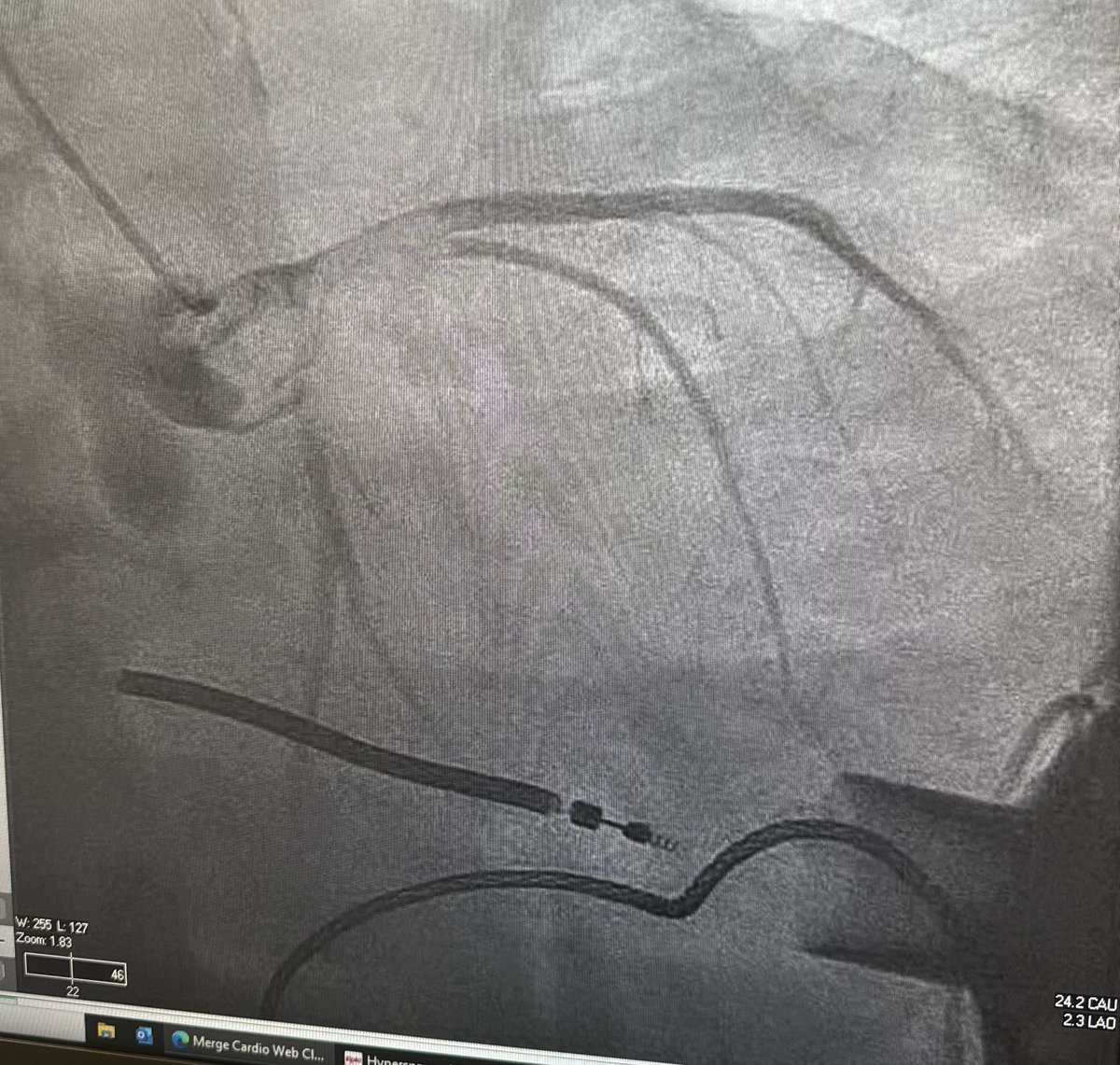 New fear unlocked. Consequence of low flow across aortic valve in a HM3 pt. 
<a href="/JRWinterfield/">Jeffrey Winterfield</a> <a href="/RyanTedfordMD/">Ryan J Tedford MD</a> @Brian_Houston12