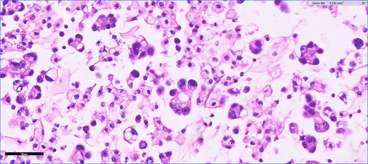 rcariascalix's tweet photo. A beautiful  Lung Adenocarcinoma cytology !!! https://t.co/jJz2bLrRx0