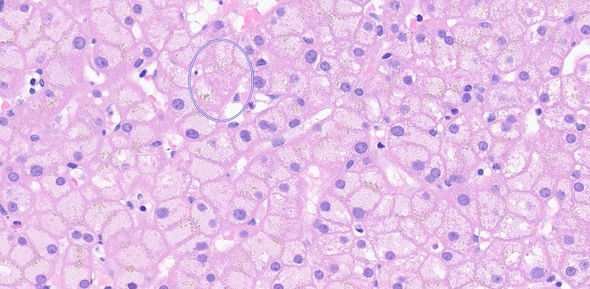 🔬 Ground-glass hepatocytes:
- eosinophilic granular, glassy cytoplasm
- hyperplasia of smooth endoplasmic reticulum displaces other organelles to the cell periphery
- occasional megamitochondrias
- etiology: metabolic liver disease

#pathology #LiverPath #hepatology #PathTwitter