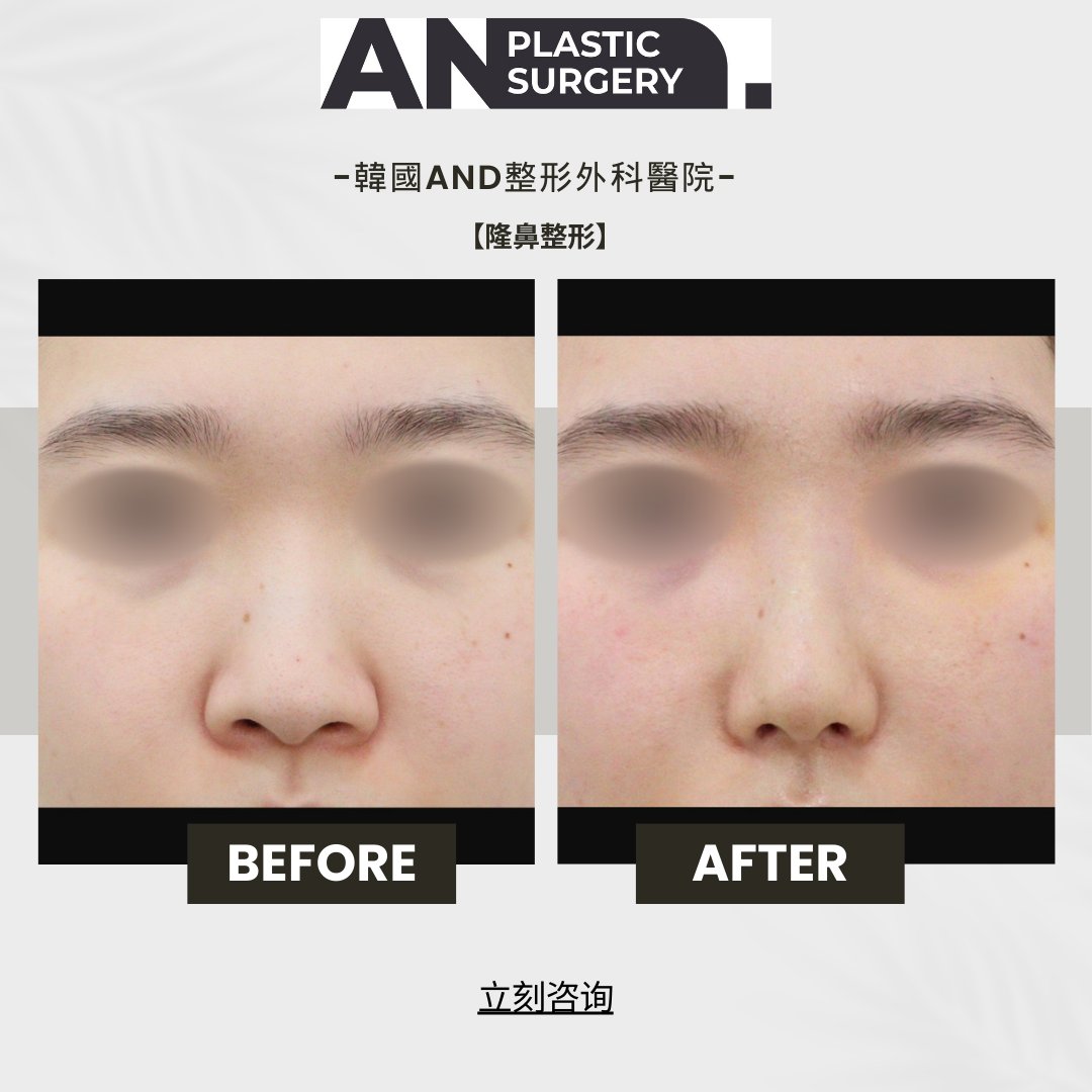 想做雙眼皮重修？先搞懂「疤痕成熟期」才是成功關鍵！ - 心湛美學診所｜專業醫美整形服務｜天鵝頸、眼袋提眉及隆乳手術, image size:1080x1080