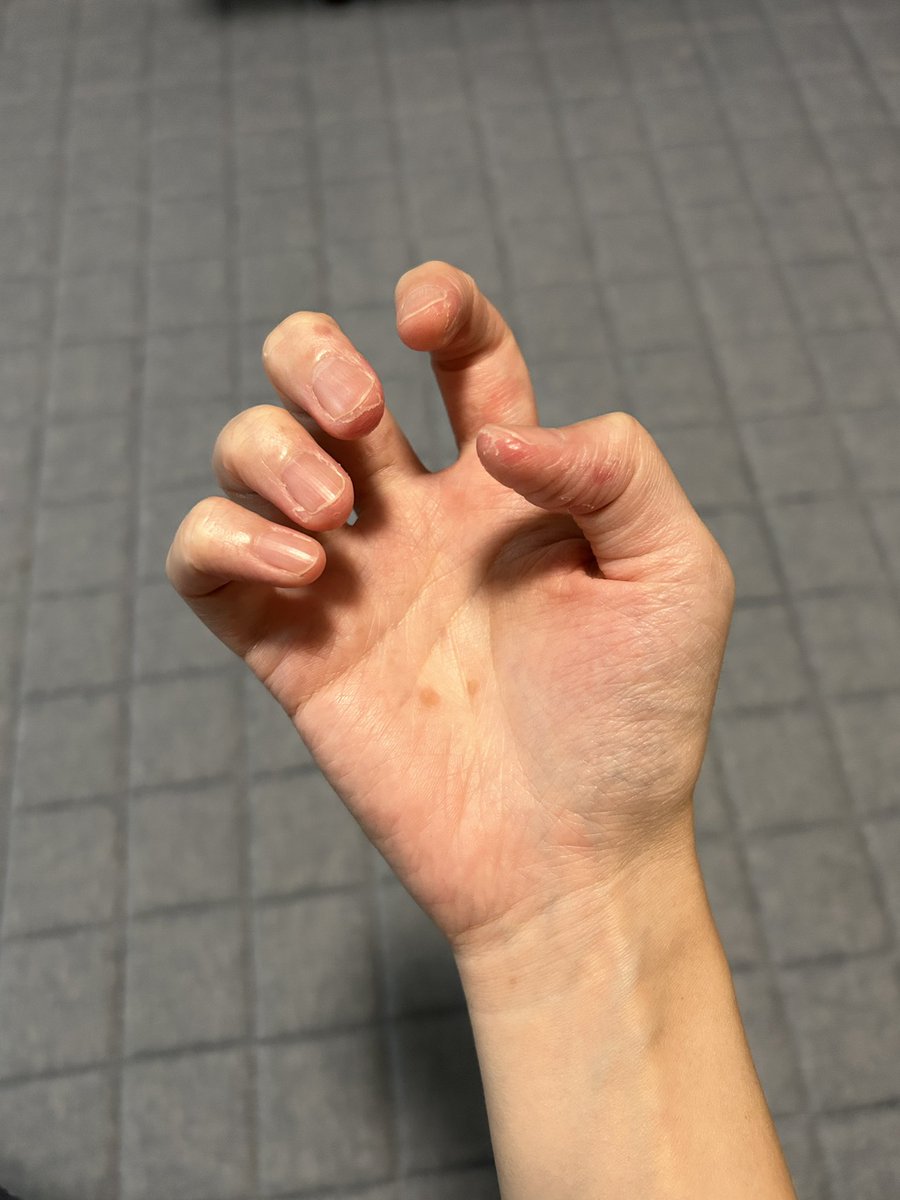 ちなみに、発症から1週間ほど経って、
指先の皮がボロボロ剥け始めました…。
オムツ交換や着替えのたびに引っかかるから辛いです…。