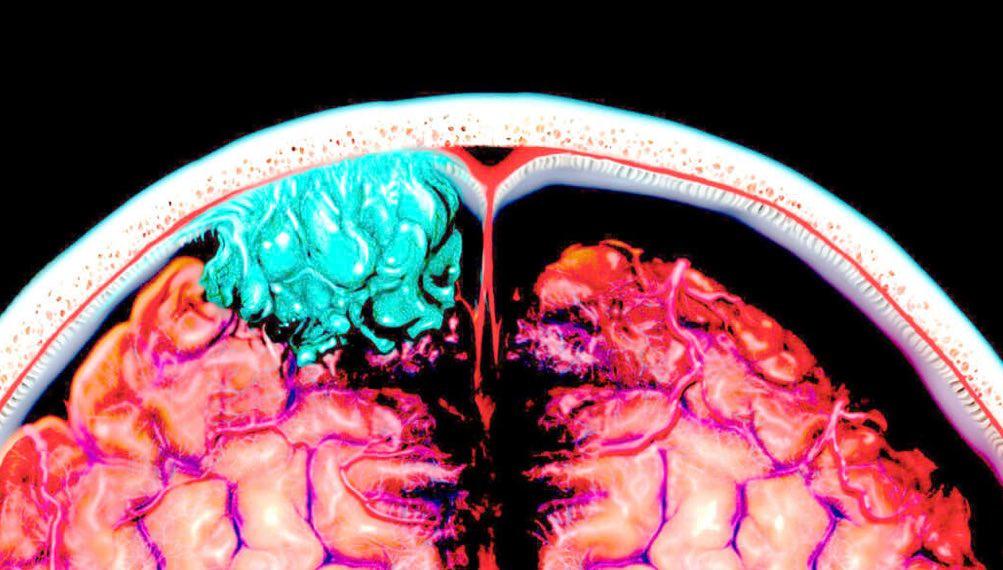 MayoClinicNeuro's tweet image. Mayo Clinic clinician-researchers and scientists investigate better ways to diagnose and treat all types of #braintumors. Findings from #clinicaltrials are applied to address unmet patient needs in the clinic. Learn more: mayocl.in/3RPWBoa