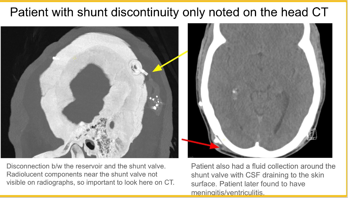 learnneurorad's tweet photo. When evaluating shunted ventricles, it’s not only important to compare ventricular size, but also assess the radiopaque and radiolucent components of the shunt for discontinuity. #neurorad #radres @thecortexclub @CooperRadRes https://t.co/R53iBwXdKb