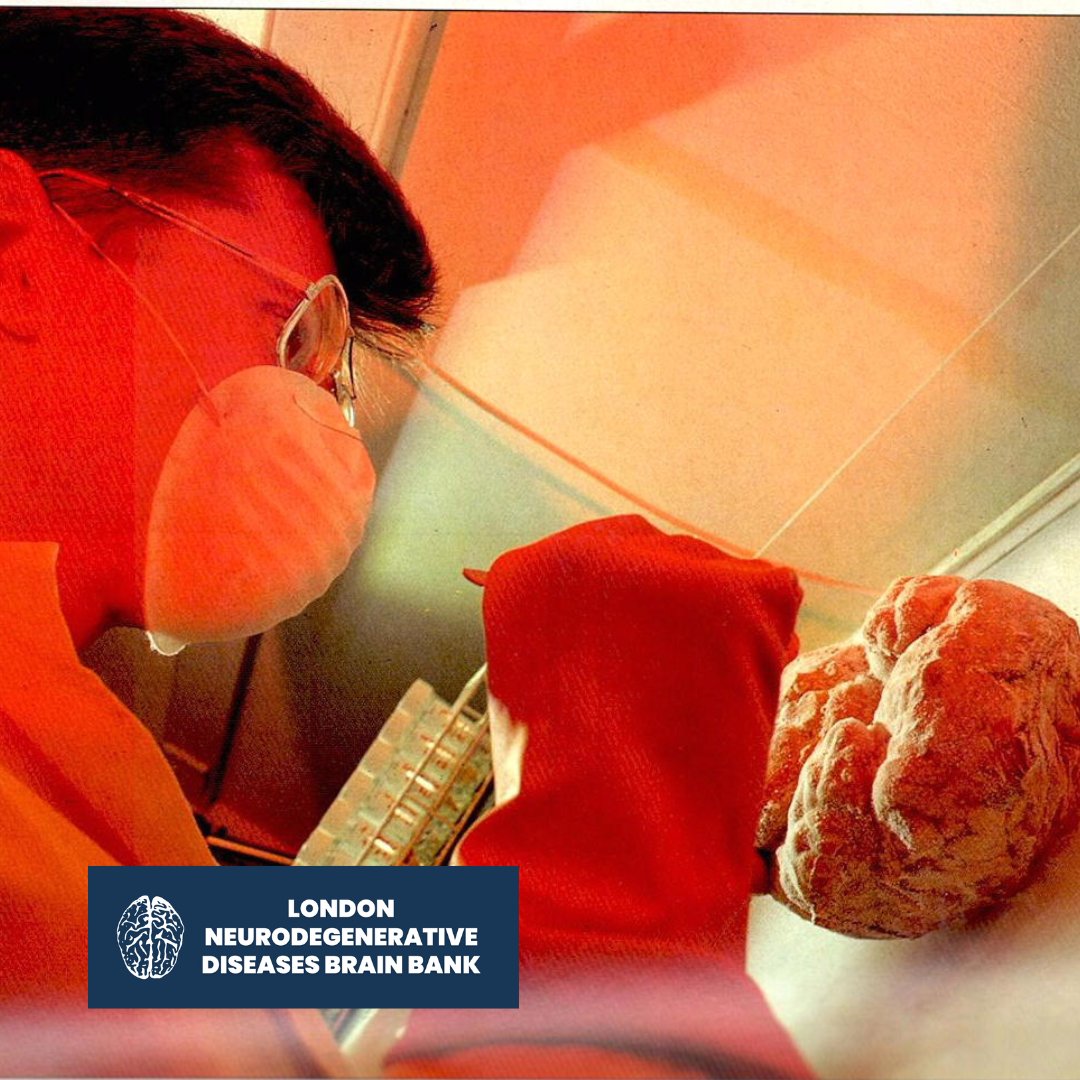 LNDBrainBank's tweet photo. An integral part of every neuropathological diagnosis is the #macroscopic analysis of the postmortem brain 🧠. Some visible changes include #atrophy or #swelling, #asymmetry, #widening of the #sulci and #gyri, focal #lesions, #inflammation, #haemorrhages, and #infarcts. https://t.co/Q1mo1xJ6Nt