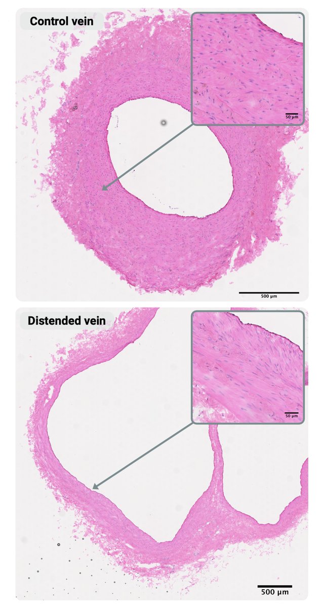 Circulation Research (@circres) on Twitter photo Michaud & colleagues used single-nuclei & spatial #transcriptomics, which revealed cell types & maladaptive pathways during #vein harvest that drive graft failure. ahajrnls.org/4bsVDFv
<a href="/marina_michaud/">Marina Michaud</a> <a href="/mbhasin_/">mbhasin_</a> <a href="/Leenabzdyk/">Leena Pradhan-Nabzdyk</a> <a href="/LiangPatric/">Patric Liang</a>
<a href="/LReckardMota/">Lucas Reckard-Mota</a> Michaud & colleagues used single-nuclei & spatial #transcriptomics, which revealed cell types & maladaptive pathways during #vein harvest that drive graft failure. ahajrnls.org/4bsVDFv
<a href="/marina_michaud/">Marina Michaud</a> <a href="/mbhasin_/">mbhasin_</a> <a href="/Leenabzdyk/">Leena Pradhan-Nabzdyk</a> <a href="/LiangPatric/">Patric Liang</a>
<a href="/LReckardMota/">Lucas Reckard-Mota</a>