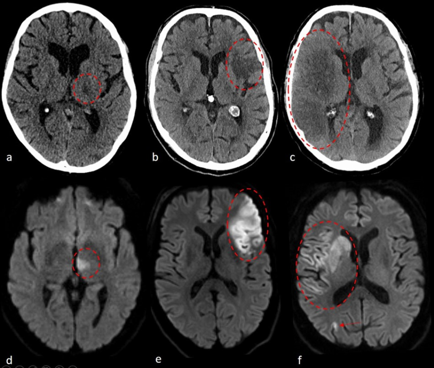 Early start of treatment with blood thinners after stroke &amp; atrial fibrillation reduces risk of recurrent stroke also in large infarcts &amp; haemorrhagic transformation. More: pubmed.ncbi.nlm.nih.gov/38805207// pubmed.ncbi.nlm.nih.gov/38753452/.
#InselGruppe #StrokeResearch #Neurology #Neuroradiology
