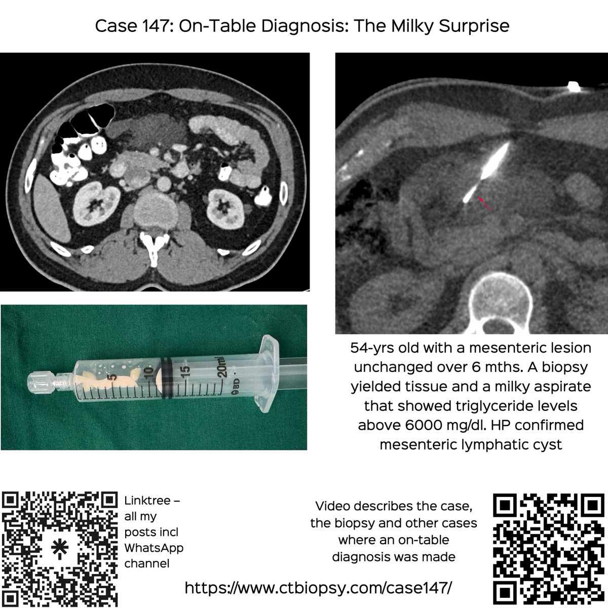 bhavinj's tweet photo. Case 147: On-Table Diagnosis - The Milky Surprise
56-years old with a mesenteric lesion and a milky aspirate.
Video discusses this and another case and the topic of on-table diagnosis during biopsies
https://t.co/F0d9jWAX9a
#ctbiopsy #irrad #mesentery #lymphangioma #lymphaticcyst