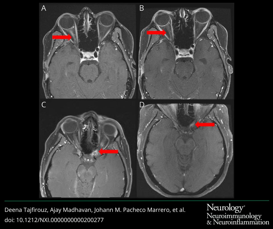 GreenJournal's tweet photo. This study suggests that in patients with #MOGAD, new asymptomatic optic nerve enhancement on MRI is likely a rare event. Most of the asymptomatic enhancement occurred at prior sites of optic neuritis attack without a difference in visual outcomes.
https://t.co/f8y3IlBT7X https://t.co/lHm7glSFkN