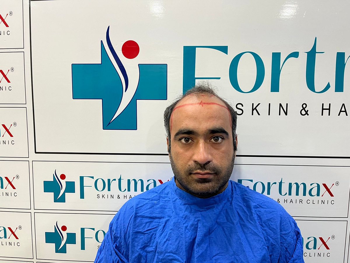 fortmaxclinic's tweet photo. Kamal kishor #Nagour #Rajasthan #HairTransplant at our #Jaipur centre on 02/07//2024 with FUE & DHI technique (4500graft )
#FortMaxClinic #HairTransplant #HairRestoration #HairLossSolution #ConfidenceBoost #EMIOffer #HairRevival #NewYou #HairTransformation https://t.co/TuVrLxCKjn