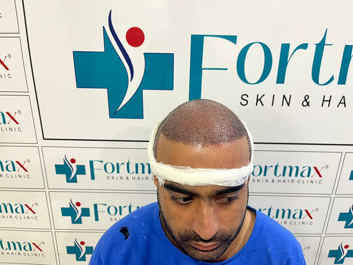 fortmaxclinic's tweet photo. Kamal kishor #Nagour #Rajasthan #HairTransplant at our #Jaipur centre on 02/07//2024 with FUE & DHI technique (4500graft )
#FortMaxClinic #HairTransplant #HairRestoration #HairLossSolution #ConfidenceBoost #EMIOffer #HairRevival #NewYou #HairTransformation https://t.co/TuVrLxCKjn