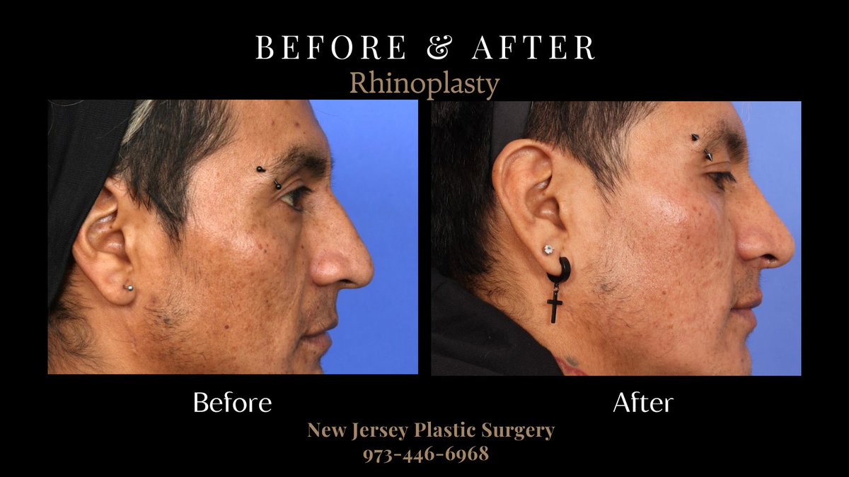 Refine your facial features with rhinoplasty at New Jersey Plastic Surgery. Our expert surgeons deliver natural-looking results tailored to your goals. Schedule your consultation today and discover a new level of confidence with NJPS!

#rhinoplasty

newjerseyplasticsurgery.com/consultation/