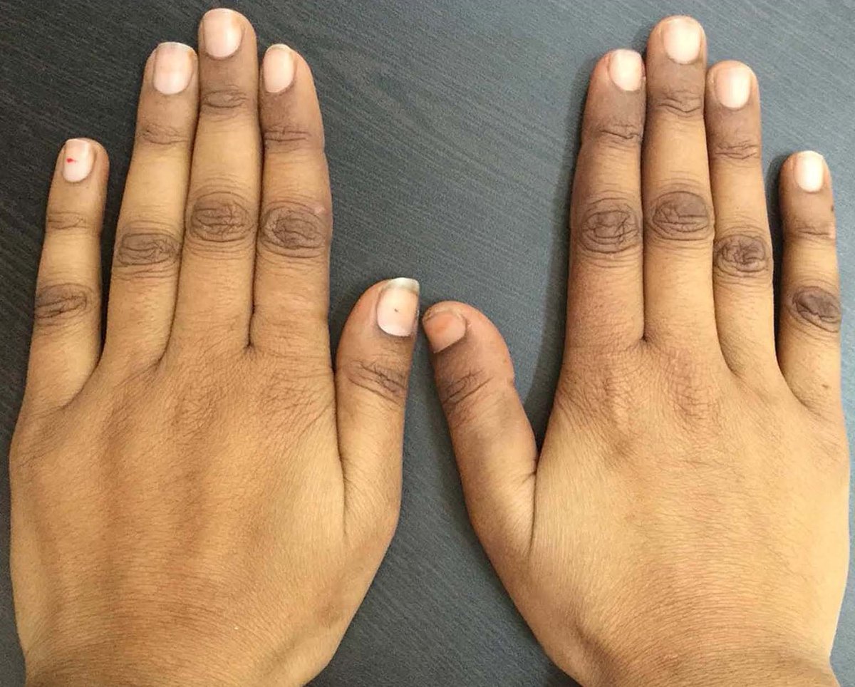 drkeithsiau's tweet photo. Hands of a patient with tiredness and breathlessness. What’s the diagnosis? https://t.co/9PXT5oVbfB