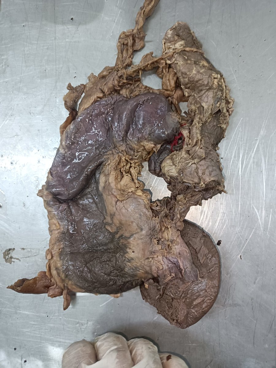 ChandanRaj72024's tweet photo. Identify the viscera??

#mbbs
#medicine #MedicinaInterna #ฟินไม่มีเบรกฟรีนเบค #DoctorsDayIndia #ฟินไม่มีเบรกฟรีนเบค #legislatives2024 https://t.co/lp9JBnZCcH