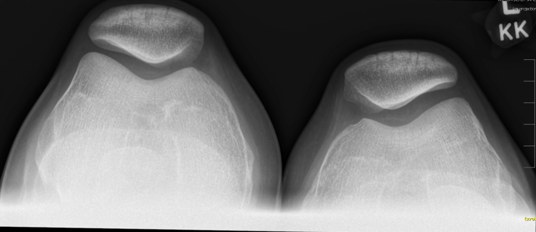 There are a number of factors that can lead to patellar instability.  These factors include alignment, bony anatomy, and soft tissue deficits.  We are studying the interactions of these risk factors so that surgeons can better address the underlying pathology.