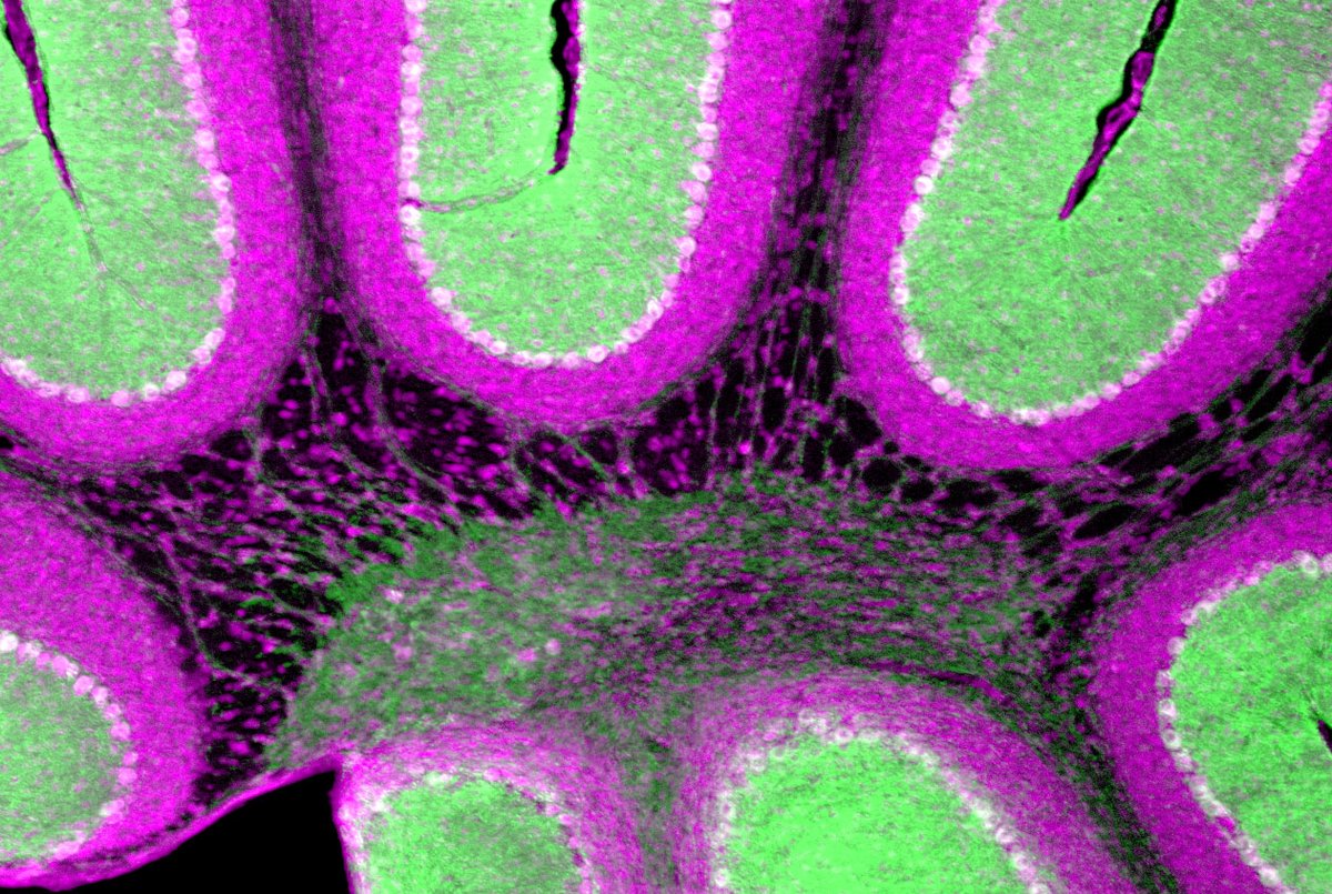 TCHResearchNews (@tchresearchnews) on Twitter photo By finding distinct neural codes for abnormal movements seen in #ataxia, #dystonia & #tremors, a recent study in <a href="/eLife/">eLife - the journal</a> led by Dr. <a href="/SillitoeLab/">Sillitoe Lab</a> <a href="/bcmhouston/">BCMHouston</a> <a href="/TexasChildrens/">Texas Children's</a> & Dr. <a href="/Meikeesther1/">Meike E van der Heijden, PhD</a> opens the door to a new approach to treat movement disorders: bit.ly/3xE1Ssf By finding distinct neural codes for abnormal movements seen in #ataxia, #dystonia & #tremors, a recent study in <a href="/eLife/">eLife - the journal</a> led by Dr. <a href="/SillitoeLab/">Sillitoe Lab</a> <a href="/bcmhouston/">BCMHouston</a> <a href="/TexasChildrens/">Texas Children's</a> & Dr. <a href="/Meikeesther1/">Meike E van der Heijden, PhD</a> opens the door to a new approach to treat movement disorders: bit.ly/3xE1Ssf