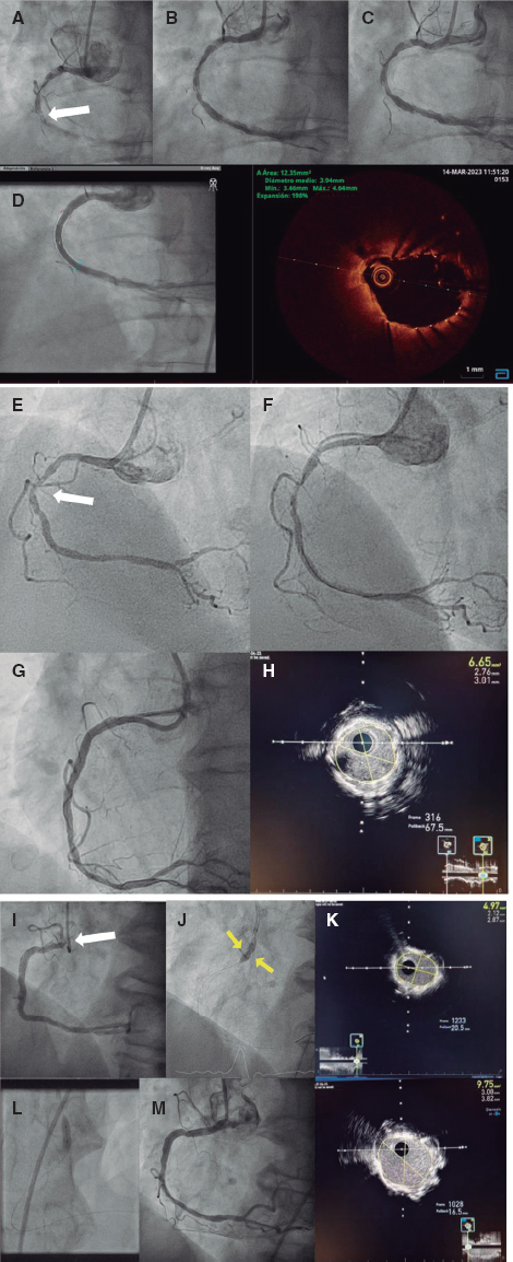 RevEspCardiol's tweet photo. Possible delayed effectiveness of intracoronary laser atherectomy  #recintervcardiol  @650Torres @JuradoRomanAl @RuizNodarJM https://t.co/gAAdms8E8E https://t.co/N3m8NGJgXH