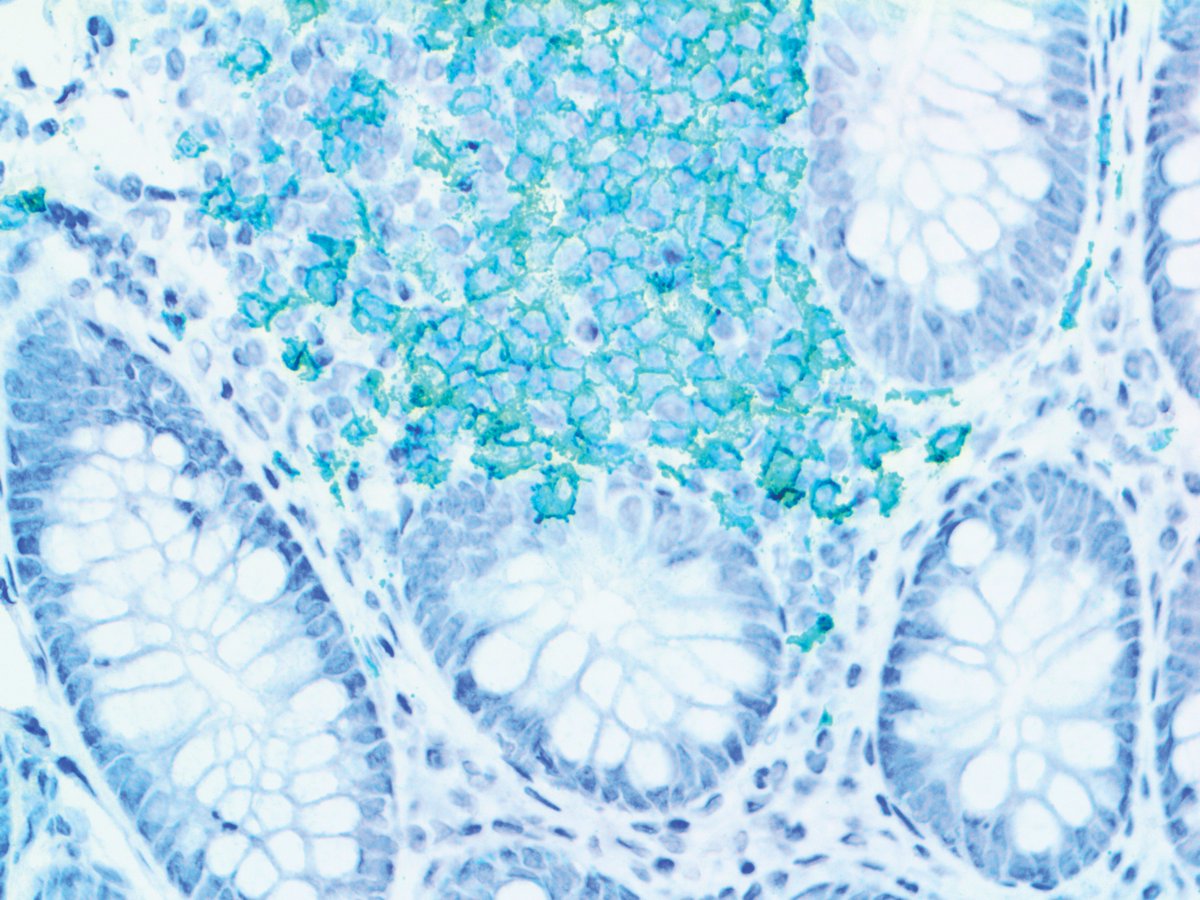 Have you heard of CD3-epsilon polypeptide? It plays an essential role in T-cell development. Defects in the CD3E gene cause immunodeficiency and have also been linked to a susceptibility to Type I Diabetes in women.

To learn about CD3 Epsilon, or to peruse our catalog of over