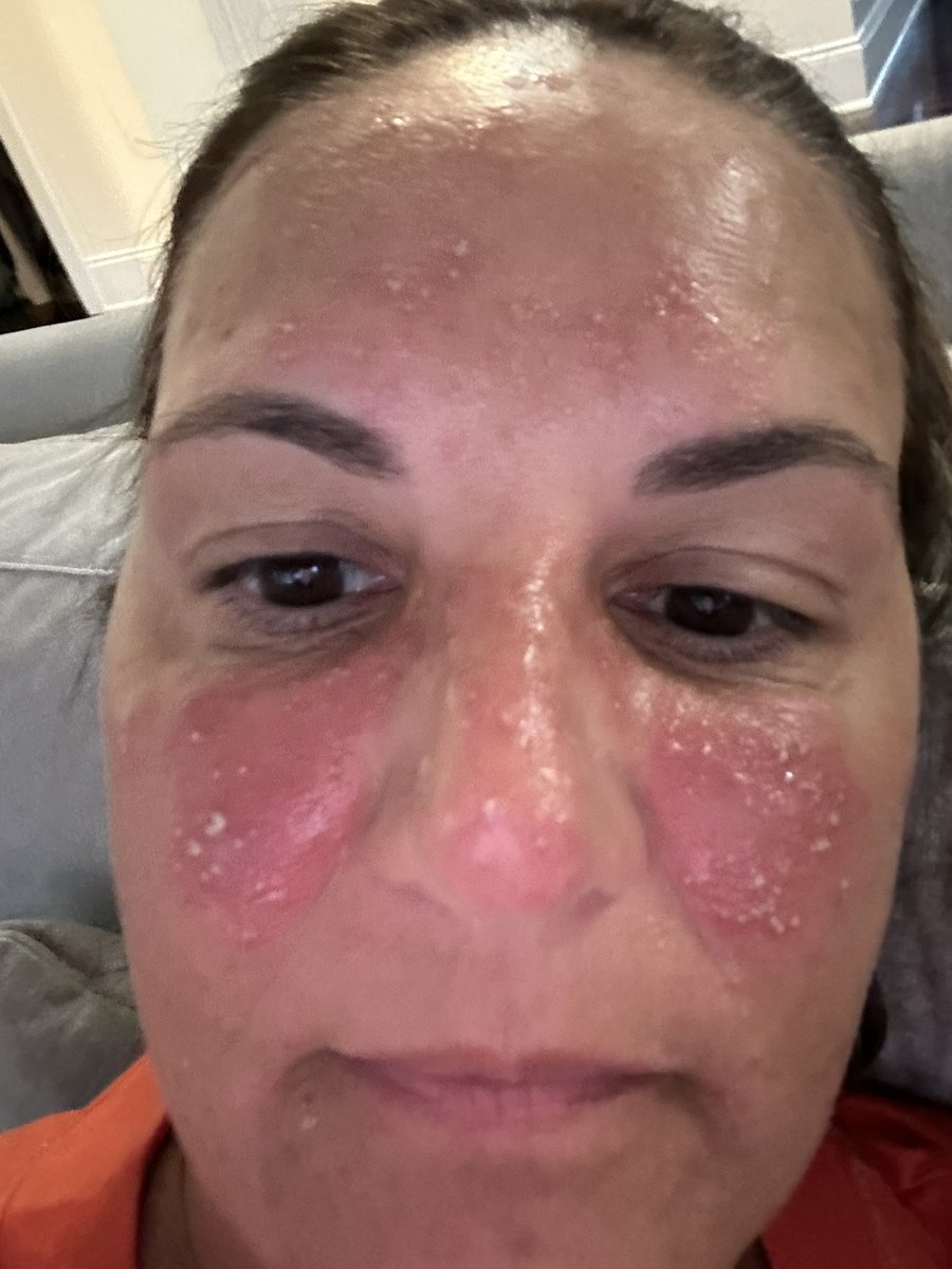 motherofswans's tweet photo. Day 17- this is NOT ok -ouch. Any studies showing a lower dose as effective??  #EGFR #NSCLC #tagrisso https://t.co/Ioe61cfQfU
